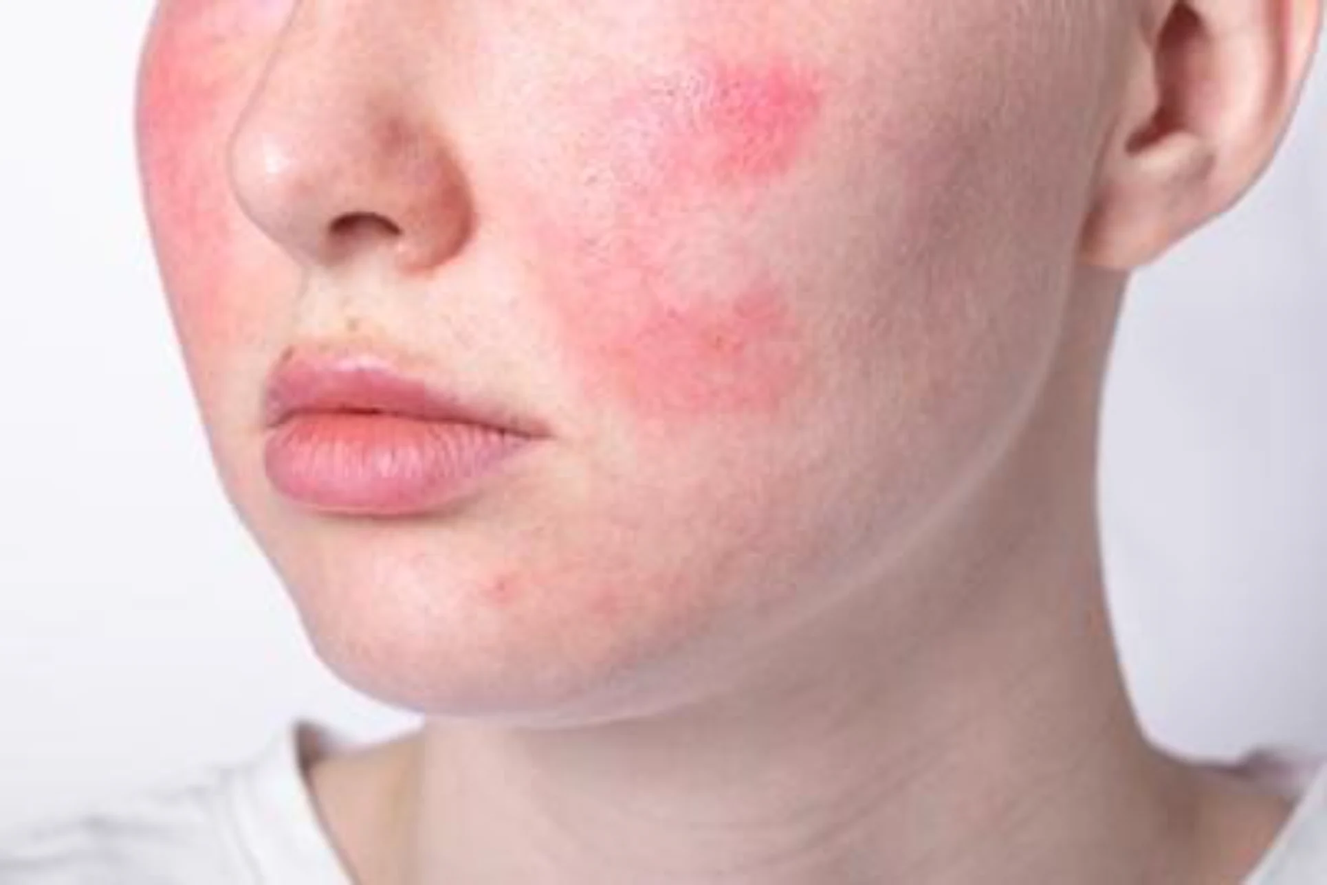 Facial dermatitis treatment in Ithaca NY