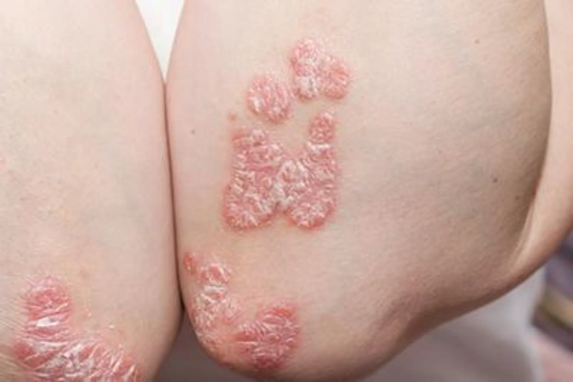 Clustered skin rash treatment in Ithaca NY