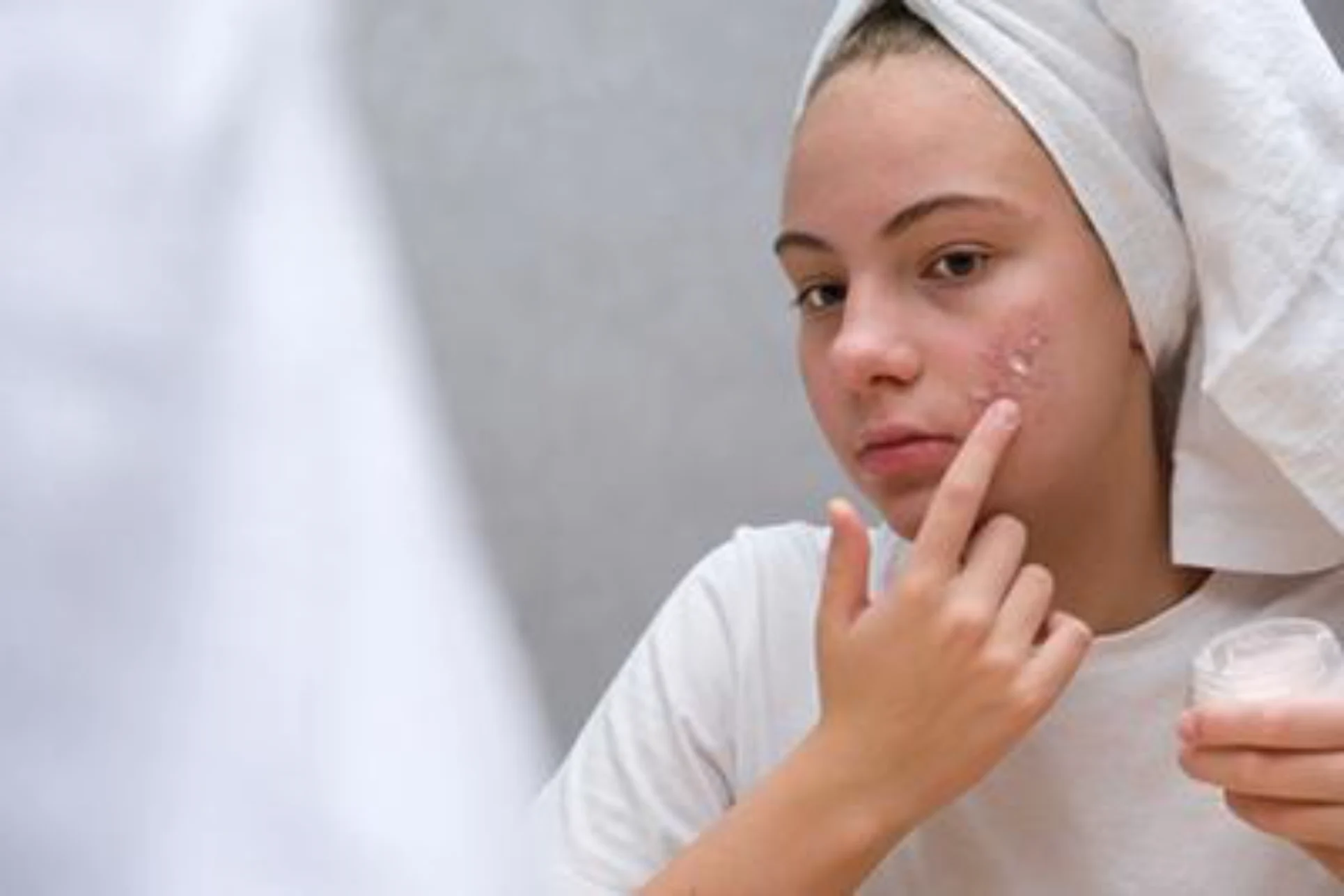 Acne spot treatment consultation in Ithaca NY